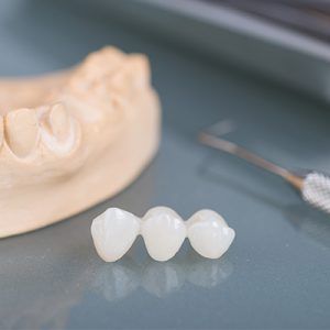 dental bridges photo