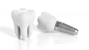 dental implants photo