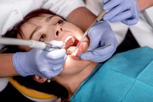 dental sealants photo