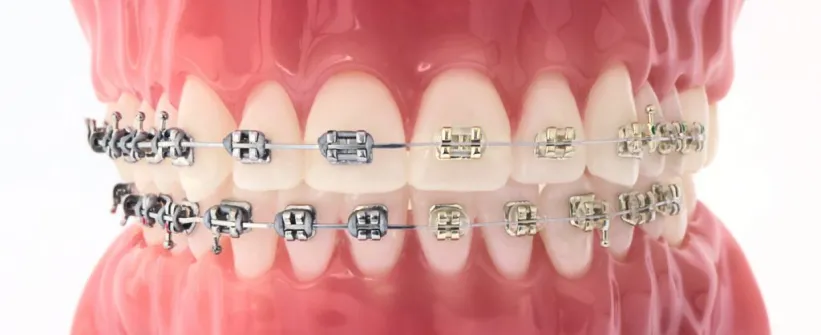 iconix braces photo