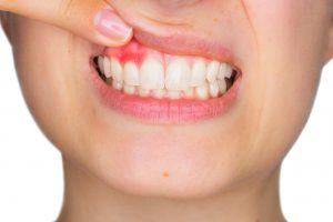 periodontal maintenance photo