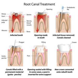 root canal photo