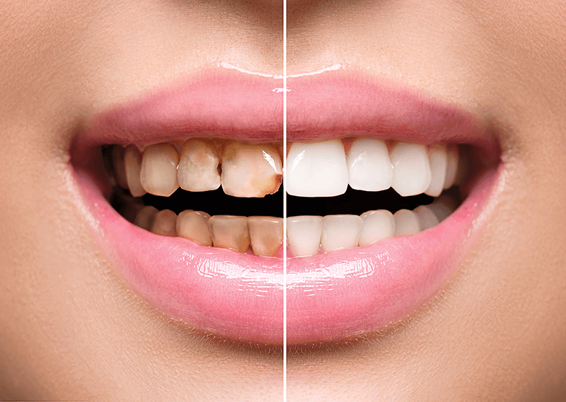 smile makeover photo