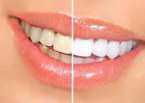 teeth whitening photo