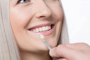 veneers photo