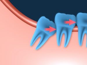 wisdom teeth removal photo